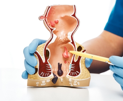 Bệnh trĩ có thể tự chữa khỏi không?
